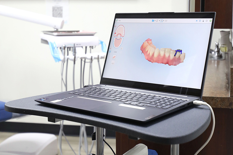 Intra-Oral Camera in 